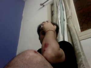 Result of Accident